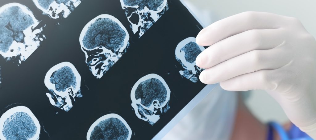 Alzheimers AI